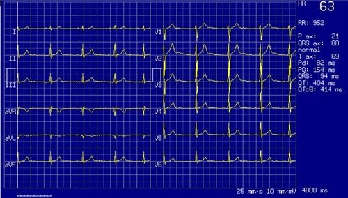 electrocardiogramme