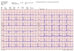 ECG