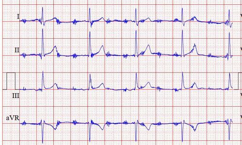 ecg storingen door omgevingsruis